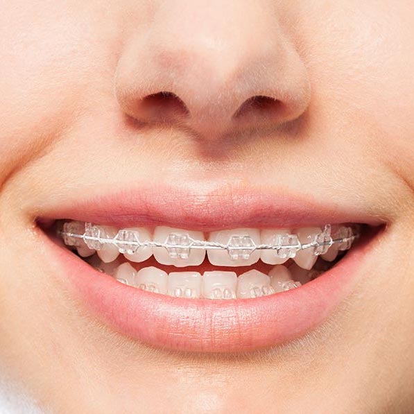 Dental Orthodontic Treatment Model (Metallic/Ceramic) Brackets